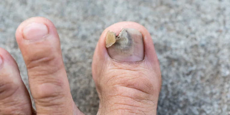 Toenail Fungus