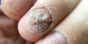Fungal Infections