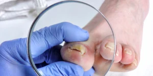 Toenail Fungus