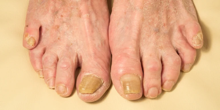 Nail Infections